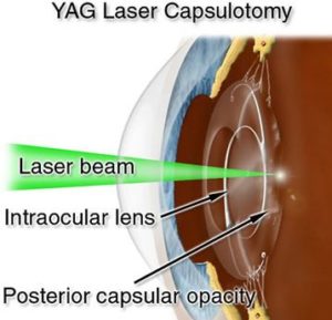 Yag Laser Capsulotomy Newview Eye Center Newview Eye Center